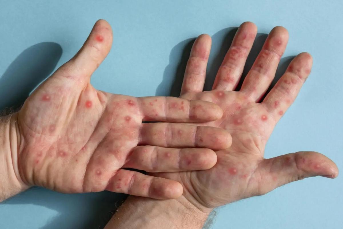 Cidade de São Paulo registra 22 novos casos de mpox em uma semana.